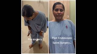 Endoscopic Spine treatment  Transforming lives happypatient painfreelife Sanchetispinepune [upl. by Assej407]