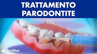 Trattamento parodontite – Curettage e sondaggio parodontale © [upl. by Ahsote]