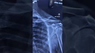 Collarbone fracture Treatment without operation100results MYSORE BONE setter bonesettingspecialist [upl. by Jangro]