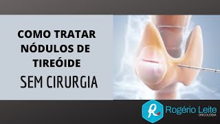 Como Tratar Nódulo De Tireoide Sem Cirurgia Dr Rogério Leite [upl. by Gladis]