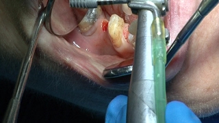 Implantes endodoncia coronas  Odontologia Multidisciplinar Dentistry Multidisciplinary [upl. by Madaras]