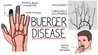 Understanding Buerger Disease Thromboangiitis Obliterans [upl. by Cornell812]