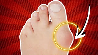 How To Fix Bunions Without Surgery [upl. by Ziagos182]