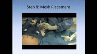 SAGES Pearls Session Laparoscopic Inguinal Hernia Repair Introduction  Technique Video [upl. by Keram]