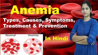 Anemia  Types of Anemia  Causes Symptoms Treatment Prevention Risk Factors  In Hindi [upl. by Hughie]