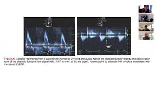 Diastolic LVEDP [upl. by Hans]