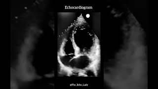 Takotsubo🐙 cardiology echocardiogram heartscan Takotsubo [upl. by Gayle853]