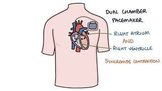 Understanding Pacemakers [upl. by Alset]