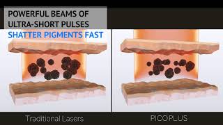 Pico Laser Pigmentation Treatment in Singapore  Sozo Aesthetic Clinic Dr Justin Boey [upl. by Fan]