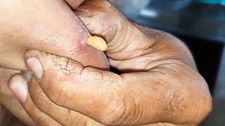 ❌️ COMO REMOVER BERNE DO BRAÇO DIREITO larva na mosca [upl. by Lledrev]