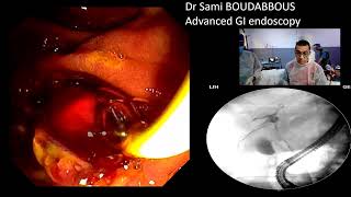 ERCP for acute cholangitis  hydatic cyst [upl. by Leik198]