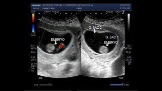 Ultrasound Video showing Vanishing twin syndrome with one normal fetus alongside a blighted ovum [upl. by Jozef205]