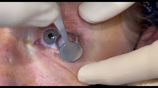 Chalazion Incision and Drainage Procedure [upl. by Hsima]