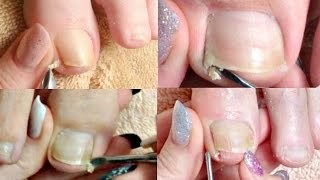 1 Pedicure Tutorial Big Toenail Cleaning Compilation Real Time ✔ [upl. by Carmel]