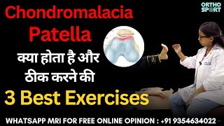 Chondromalacia Patella क्या होता है और ठीक करने की 3 Best Exercises chondromalaciapatella [upl. by Mittel560]