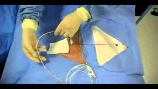 Insertion of Transvenous Pacemaker [upl. by Lancelle237]