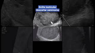 BOLITA TESTICULAR EN UN ULTRASONIDO [upl. by Narah]