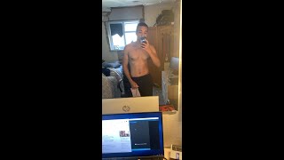 GYNECOMASTIA Surgery  Story  Before amp After results CHECK MOST RECENT VID FOR UPDATE [upl. by Angie317]