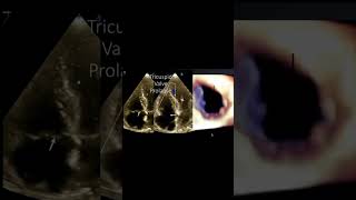 Tricuspid Valve Prolapse [upl. by Frasco]