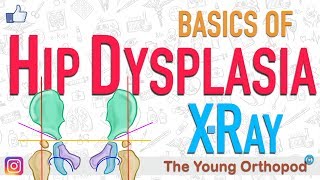 Developmental Dysplasia of Hip DDH X Ray features NEET PG USMLE Dysplastic hip CDH [upl. by Suneya]