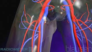 Pulmonary Embolism [upl. by Chaworth]