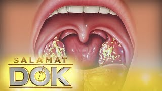 Salamat Dok Information about tonsil stones [upl. by Inatsed]