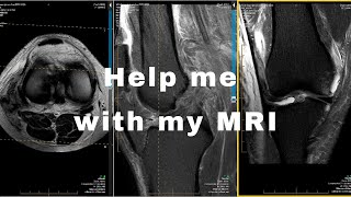 Most Commonly Imaged Knee Injuries On MRI [upl. by Conall]