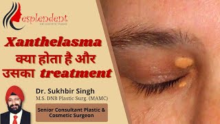 Xanthelasma removal in Hindi  How to get rid of fat  How to remove Xanthelasma from eyelids [upl. by Verda]