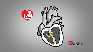 Supraventricular Tachycardia [upl. by Dettmer912]