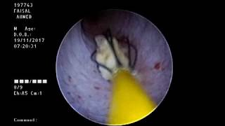 URS for Impacted Intramural Ureteric Stone DrAlAdimi [upl. by Asilram503]