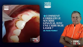 Comment corriger le sourire gingival avec une chirurgie laser   Dr Pourrat [upl. by Ezalb]