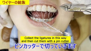 【Orthodontics】Wire replacement procedure in orthodontic treatment 歯列矯正ワイヤー交換の処置 [upl. by Otrebide974]