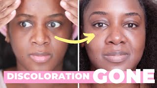 How I Got Rid of My Dark Circles Black Skin [upl. by Kcorb]