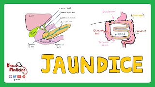 JAUNDICE Differential diagnosis of Jaundice  PrehepaticHepaticPost Hepatic Causes of Jaundice [upl. by Alyam]