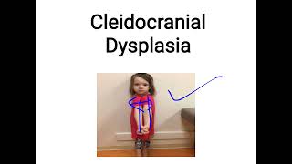 cleidocranial dysplasia [upl. by Aerdnaeel]