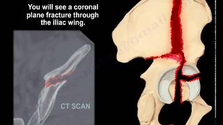 Acetabular Fracture Associated BOTH Columns  Everything You Need To Know  Dr Nabil Ebraheim [upl. by Nations]