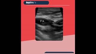 Lower Extremity Vascular POCUS for Beginners DVT 101 pocus ultrasound meded [upl. by Atiuqrahc]