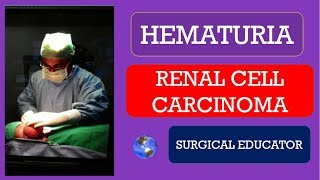 RENAL CELL CARCINOMA  How To DIAGNOSE amp TREAT HEMATURIA [upl. by Bultman]