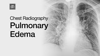 Chest Radiography Pulmonary Edema [upl. by Chak]