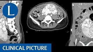 A wandering spleen splenomegaly hypersplenism and iron deficiency anaemia [upl. by Linneman178]