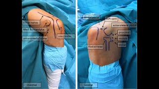 Arthroscopic ECRB tenotomy [upl. by Idnod]