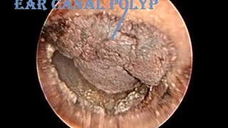 Dried Hemorrhagic Ear Canal Polyp Removal amp Cleaning [upl. by Assanav]