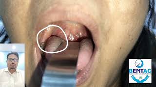 information about tonsillolith and tonsil stone removal in hindi [upl. by Drolet]