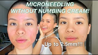 Microneedling my acne scars l Day 1 to 5 healing process [upl. by Rexanna724]