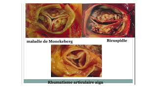 rétrécissement aortique [upl. by Ingrim]
