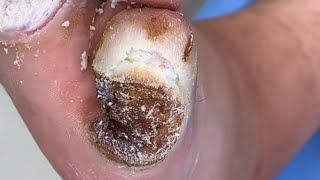 plantar warts resolved after eight treatments and clearancePedicure video 43vertical plantaris feet [upl. by Saxen]