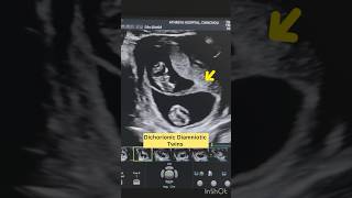 “Key Ultrasound Findings in Dichorionic Diamniotic Twins” [upl. by Alimrahs236]