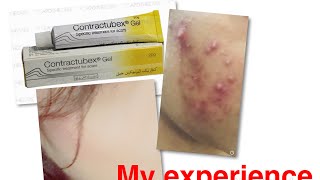 Contractubex gelbest gel for acne and scarsWith my acne pics must watch👍 [upl. by Yremogtnom]