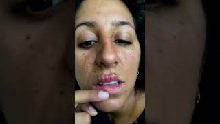 Cystic acne and blackheads removal  Newest pimple pops for 2022 [upl. by Thema346]