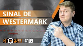 SINAL DE WESTERMARK  COMO RELACIONÁLO À TEP [upl. by Stanislaw]